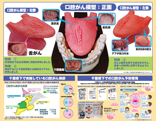 口腔がんポスター